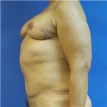 Breast Reconstruction After Photo by Michael Fallucco, MD, FACS; Jacksonville, FL - Case 30991