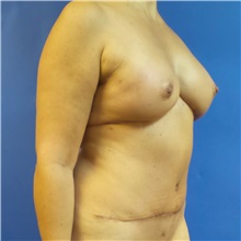 Breast Reconstruction After Photo by Michael Fallucco, MD, FACS; Jacksonville, FL - Case 30992