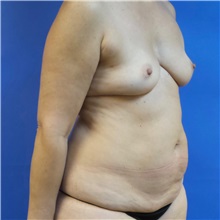 Breast Reconstruction Before Photo by Michael Fallucco, MD, FACS; Jacksonville, FL - Case 30992
