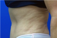 Liposuction After Photo by Michael Fallucco, MD, FACS; Jacksonville, FL - Case 34043