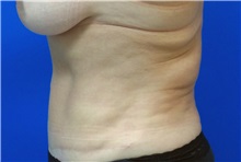 Liposuction Before Photo by Michael Fallucco, MD, FACS; Jacksonville, FL - Case 34043