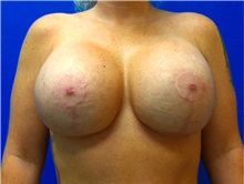 Breast Augmentation After Photo by Michael Fallucco, MD, FACS; Jacksonville, FL - Case 34046