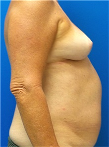 Breast Reconstruction Before Photo by Michael Fallucco, MD, FACS; Jacksonville, FL - Case 34048