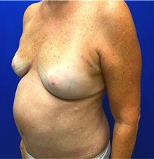 Breast Reconstruction After Photo by Michael Fallucco, MD, FACS; Jacksonville, FL - Case 34048