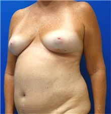 Breast Reconstruction Before Photo by Michael Fallucco, MD, FACS; Jacksonville, FL - Case 34048