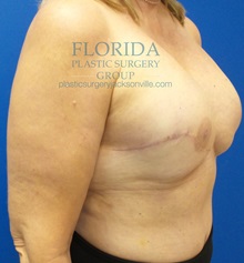 Breast Reconstruction After Photo by Michael Fallucco, MD, FACS; Jacksonville, FL - Case 34105