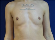 Breast Reconstruction Before Photo by Michael Fallucco, MD, FACS; Jacksonville, FL - Case 34133