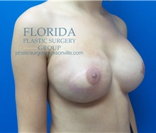 Breast Reconstruction After Photo by Michael Fallucco, MD, FACS; Jacksonville, FL - Case 34133