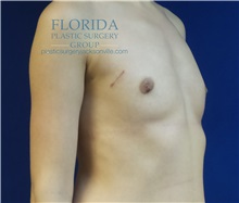 Breast Reconstruction Before Photo by Michael Fallucco, MD, FACS; Jacksonville, FL - Case 34133