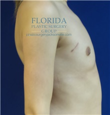 Breast Reconstruction Before Photo by Michael Fallucco, MD, FACS; Jacksonville, FL - Case 34133