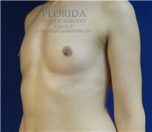 Breast Reconstruction Before Photo by Michael Fallucco, MD, FACS; Jacksonville, FL - Case 34133