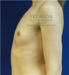 Breast Reconstruction Before Photo by Michael Fallucco, MD, FACS; Jacksonville, FL - Case 34133