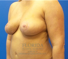 Breast Lift After Photo by Michael Fallucco, MD, FACS; Jacksonville, FL - Case 35651