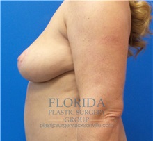 Breast Lift After Photo by Michael Fallucco, MD, FACS; Jacksonville, FL - Case 35651