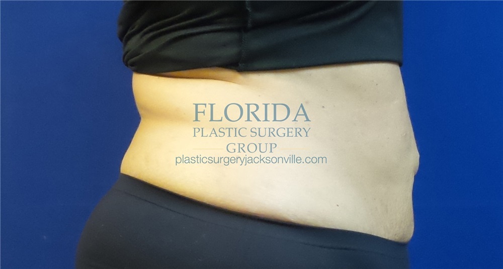 The Plastic Surgery Group Abdominoplasty