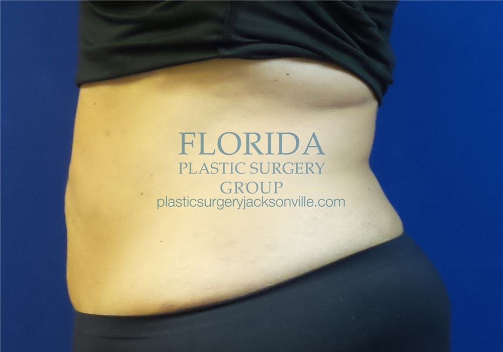 The Plastic Surgery Group Abdominoplasty