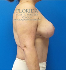 Mommy Makeover After Photo by Michael Fallucco, MD, FACS; Jacksonville, FL - Case 37912