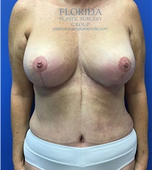Mommy Makeover After Photo by Michael Fallucco, MD, FACS; Jacksonville, FL - Case 37945