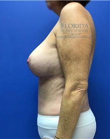 Mommy Makeover After Photo by Michael Fallucco, MD, FACS; Jacksonville, FL - Case 37945