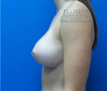 Breast Augmentation After Photo by Michael Fallucco, MD, FACS; Jacksonville, FL - Case 38244