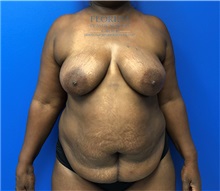Mommy Makeover Before Photo by Michael Fallucco, MD, FACS; Jacksonville, FL - Case 38339