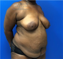 Mommy Makeover Before Photo by Michael Fallucco, MD, FACS; Jacksonville, FL - Case 38339