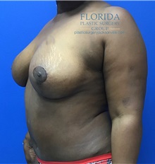 Mommy Makeover After Photo by Michael Fallucco, MD, FACS; Jacksonville, FL - Case 38339