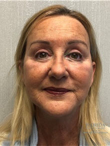 Facelift After Photo by Michael Fallucco, MD, FACS; Jacksonville, FL - Case 38582