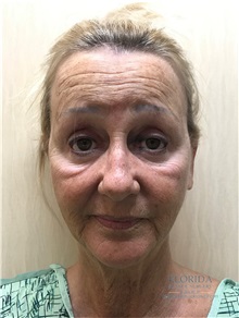 Facelift Before Photo by Michael Fallucco, MD, FACS; Jacksonville, FL - Case 38582