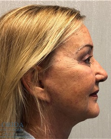 Facelift After Photo by Michael Fallucco, MD, FACS; Jacksonville, FL - Case 38582