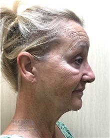 Facelift Before Photo by Michael Fallucco, MD, FACS; Jacksonville, FL - Case 38582