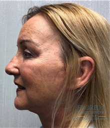 Facelift After Photo by Michael Fallucco, MD, FACS; Jacksonville, FL - Case 38582