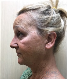 Facelift Before Photo by Michael Fallucco, MD, FACS; Jacksonville, FL - Case 38582