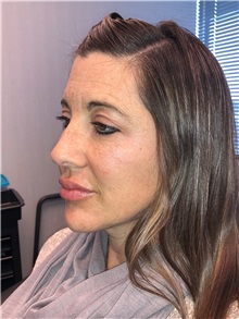 Facelift After Photo by Michael Fallucco, MD, FACS; Jacksonville, FL - Case 38583