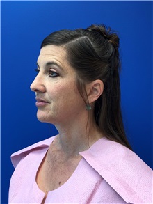 Facelift Before Photo by Michael Fallucco, MD, FACS; Jacksonville, FL - Case 38583