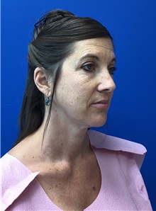 Facelift Before Photo by Michael Fallucco, MD, FACS; Jacksonville, FL - Case 38583