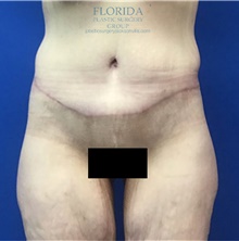 Body Lift After Photo by Michael Fallucco, MD, FACS; Jacksonville, FL - Case 38661