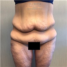 Body Lift Before Photo by Michael Fallucco, MD, FACS; Jacksonville, FL - Case 38661