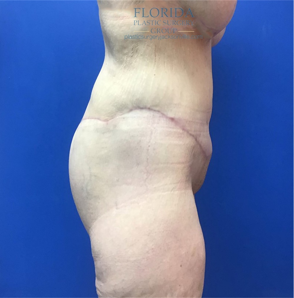 Body Lift Before and After Photos by Michael Fallucco, MD, FACS;  Jacksonville, FL - Case 38661