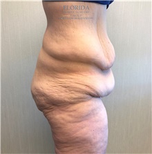 Body Lift Before Photo by Michael Fallucco, MD, FACS; Jacksonville, FL - Case 38661