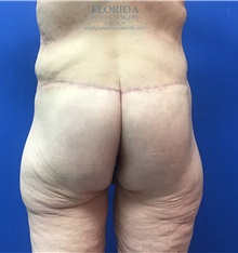 Body Lift After Photo by Michael Fallucco, MD, FACS; Jacksonville, FL - Case 38661