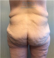 Body Lift Before Photo by Michael Fallucco, MD, FACS; Jacksonville, FL - Case 38661