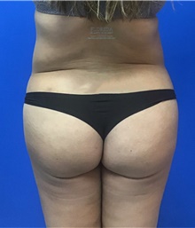 Liposuction After Photo by Michael Fallucco, MD, FACS; Jacksonville, FL - Case 38755