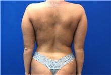 Liposuction Before Photo by Michael Fallucco, MD, FACS; Jacksonville, FL - Case 38939