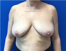 Breast Lift Before Photo by Michael Fallucco, MD, FACS; Jacksonville, FL - Case 39169