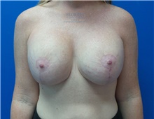 Breast Implant Revision After Photo by Michael Fallucco, MD, FACS; Jacksonville, FL - Case 40018