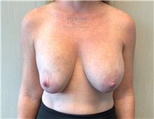 Breast Implant Revision Before Photo by Michael Fallucco, MD, FACS; Jacksonville, FL - Case 40018