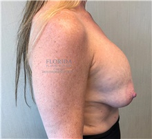 Breast Implant Revision Before Photo by Michael Fallucco, MD, FACS; Jacksonville, FL - Case 40018