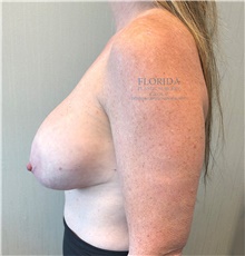 Breast Implant Revision Before Photo by Michael Fallucco, MD, FACS; Jacksonville, FL - Case 40018