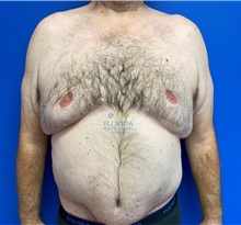 Tummy Tuck After Photo by Michael Fallucco, MD, FACS; Jacksonville, FL - Case 40623